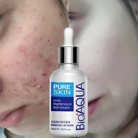 BIOAQUA - KIT COMPLETO ANTI ACNE Hermosa Universo